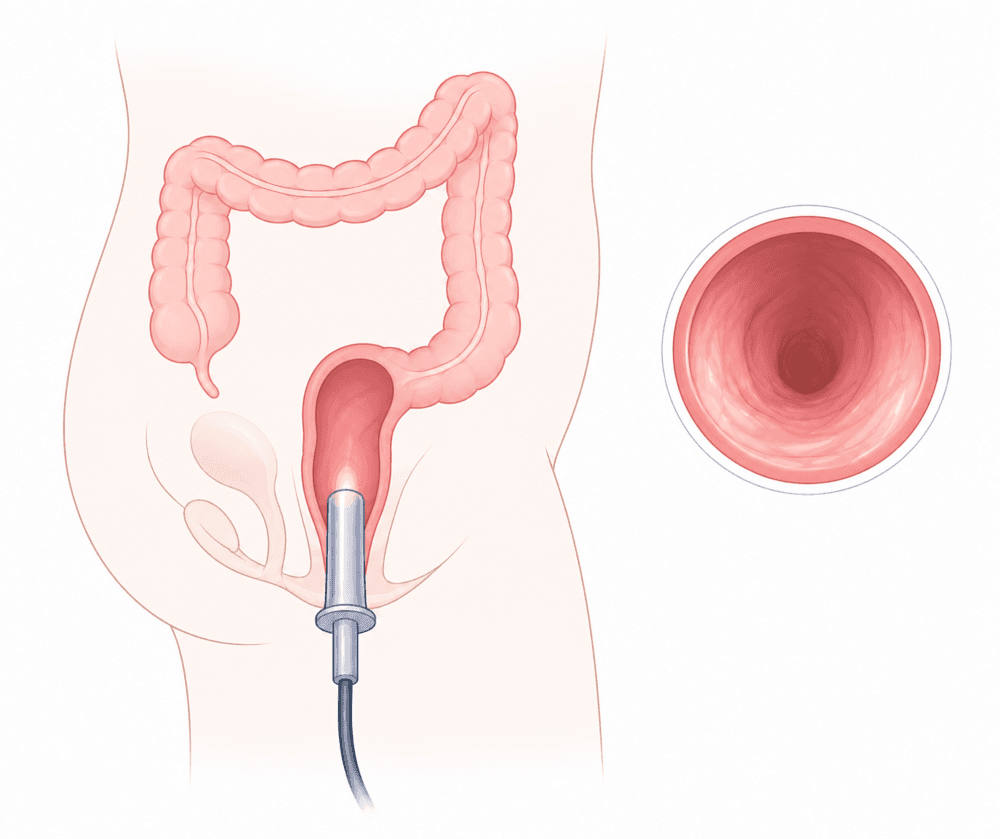 Illustration of a short, lighted examination scope placed just inside the anal canal, with a circular inset showing the smooth inner lining as the doctor sees it.