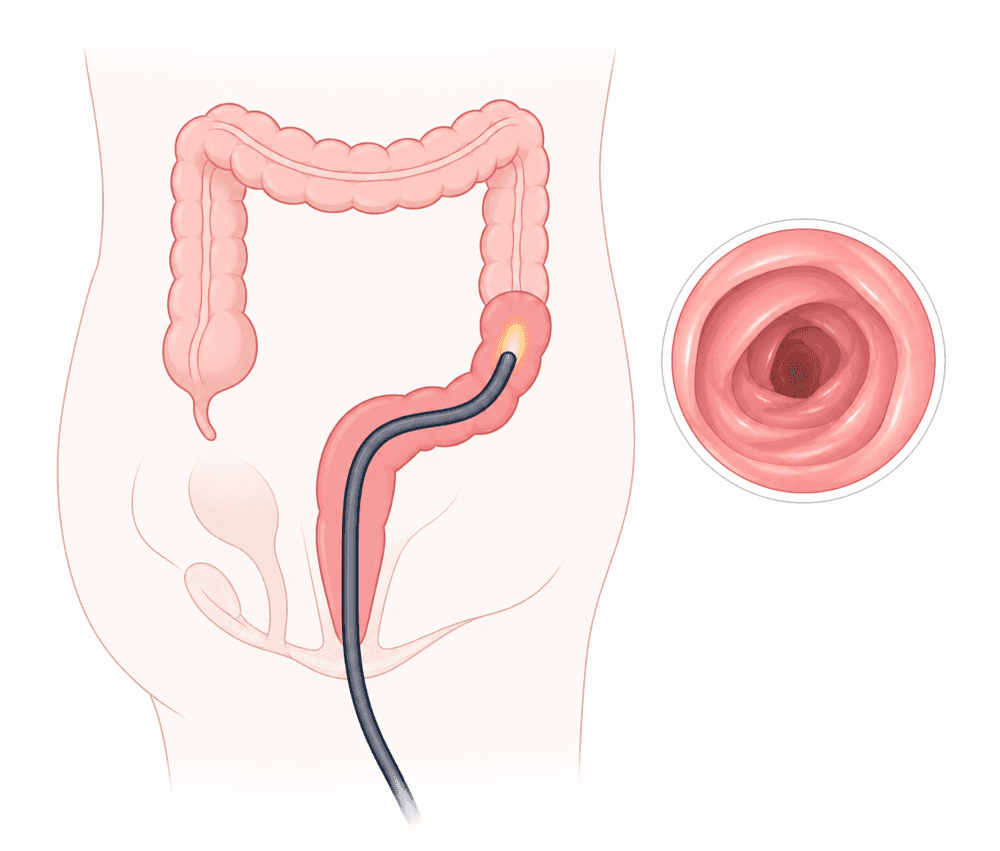Illustration of a thin, flexible camera tube passed through the rectum into the lower colon, with a circular inset showing the healthy bowel lining as seen through the scope.