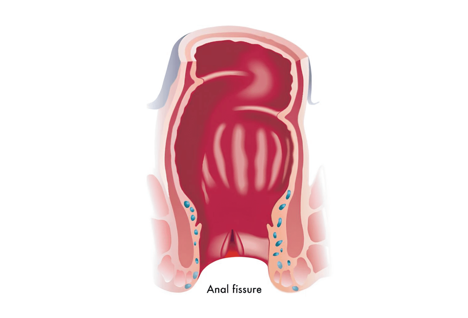 Anatomical cross-section of the anal canal, opened to show the lining. At the lower end, where the canal meets the skin, a small red split runs down the midline of the otherwise smooth pink lining.