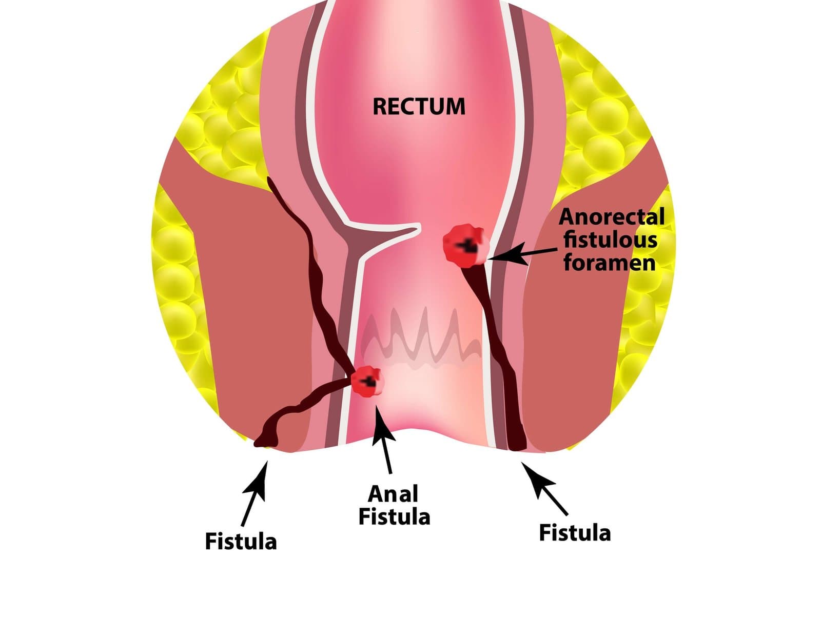 Anatomical cross-section through the rectum and anal canal. Two dark tunnels run from openings in the wall of the canal outward through the surrounding muscle and fat to the skin beside the anus, each opening marked in red.