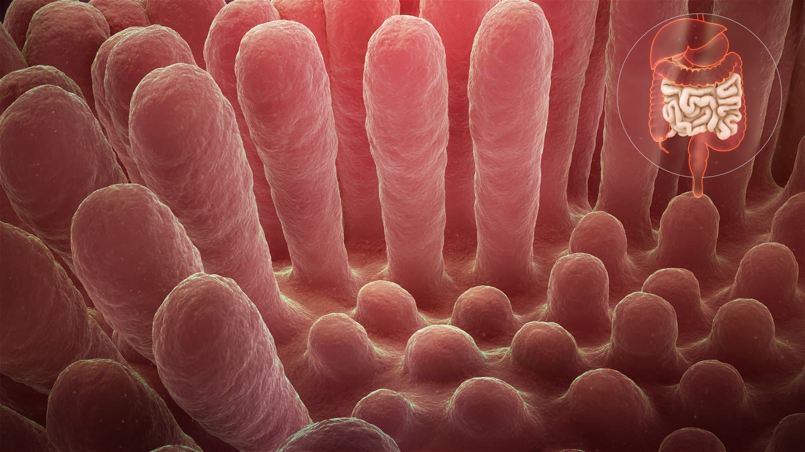 A cutaway render of the small intestine wall. Healthy finger-like villi stand tall on one side; on the damaged side they are worn flat.