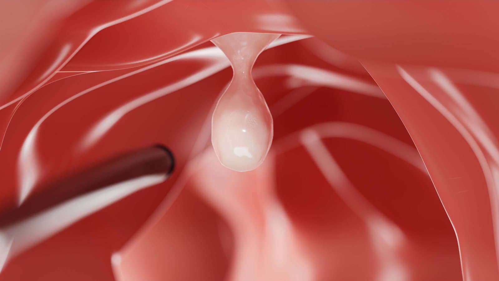 A render of the inside of the colon with a scope approaching a single raised polyp on the bowel wall.