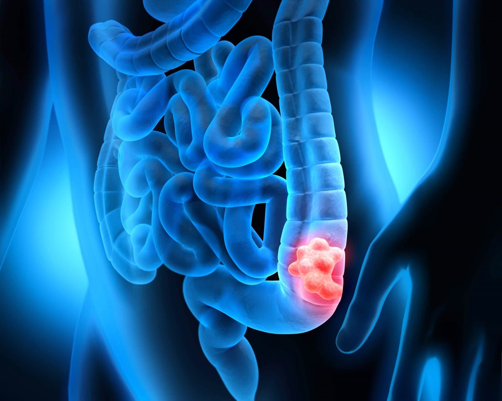 A render of a section of colon opened to show a red tumour mass growing from the bowel wall and narrowing the passage.