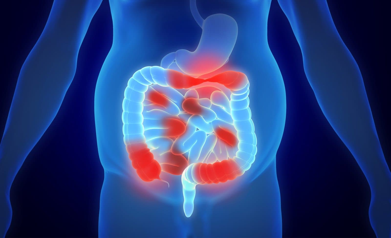 A torso seen from the front with the intestine shown through it, inflamed and lit red across separated stretches of bowel.