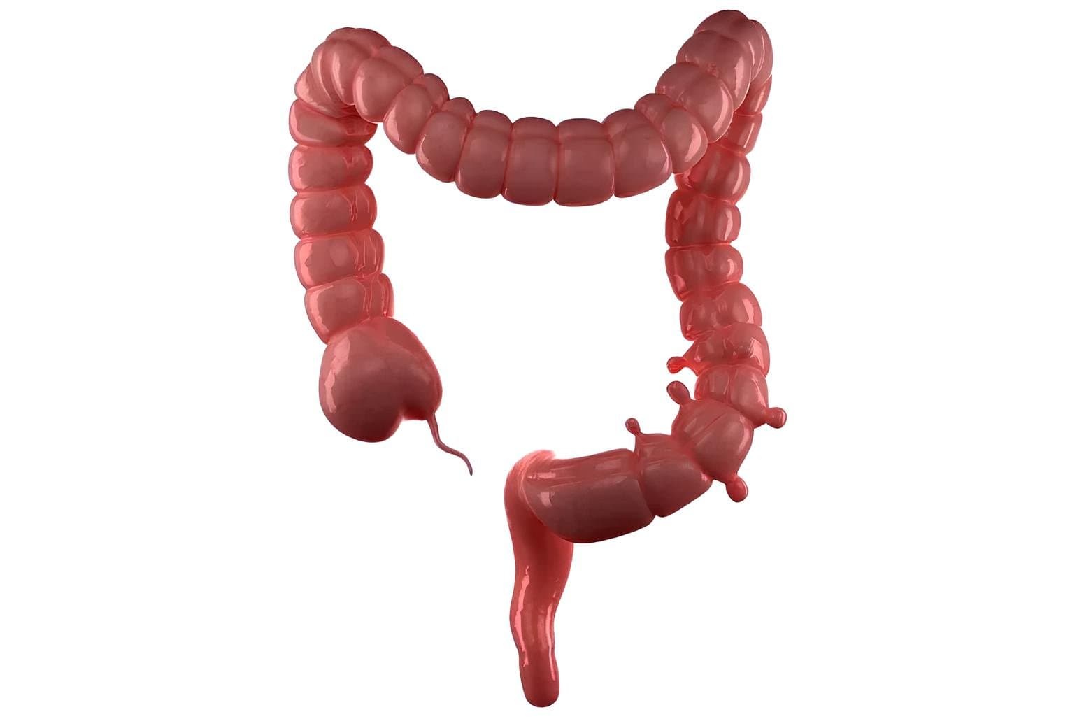 An isolated render of the large bowel with small pouches bulging outward along one stretch of its wall.