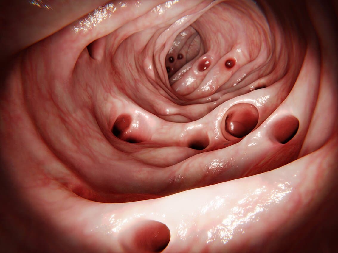 An endoscopic view along the inside of the colon showing several small pouches opening off the bowel wall.