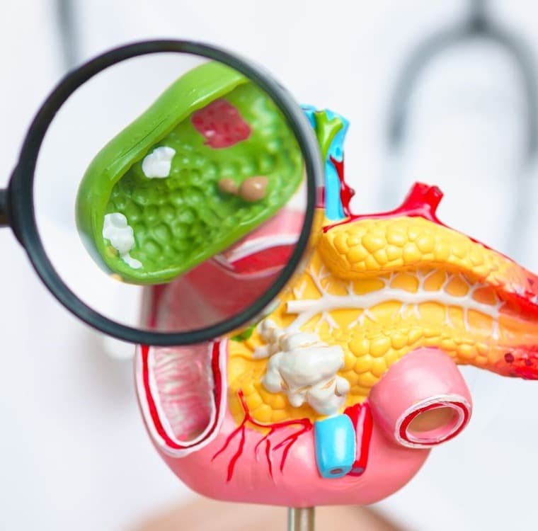 A magnifying glass held over an anatomical model of the upper abdomen, enlarging the inside of a cut-open green gallbladder that holds several small pale stones, with the pancreas and duodenum of the model beside it.