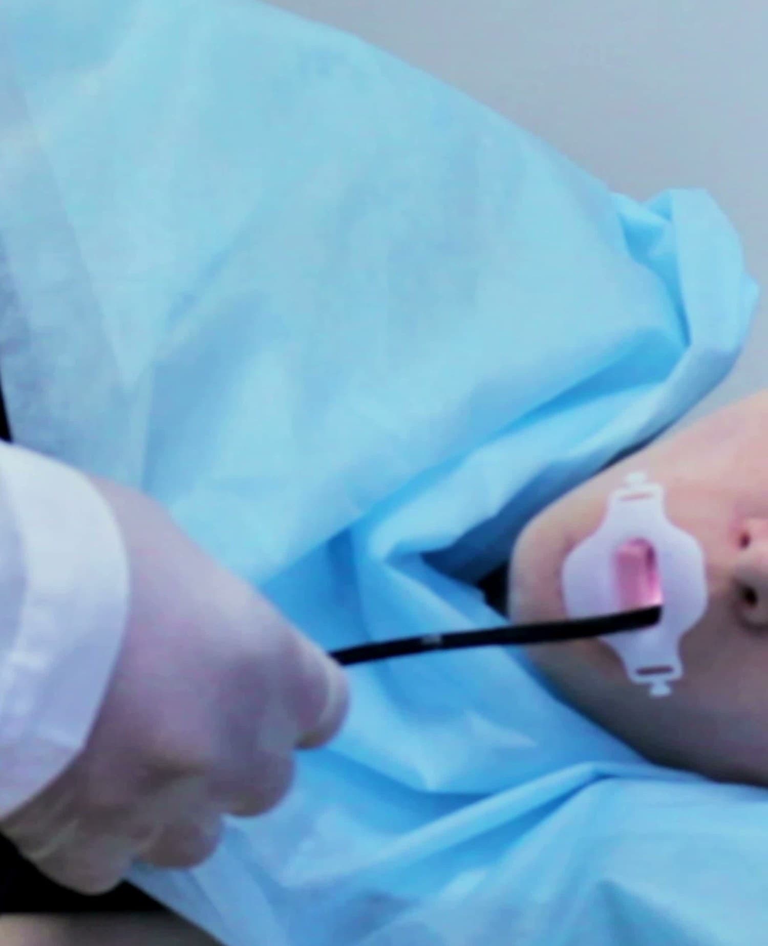 A gastroscopy under sedation: a gloved hand guides the flexible endoscope tube through the white bite guard of a draped, sedated patient.