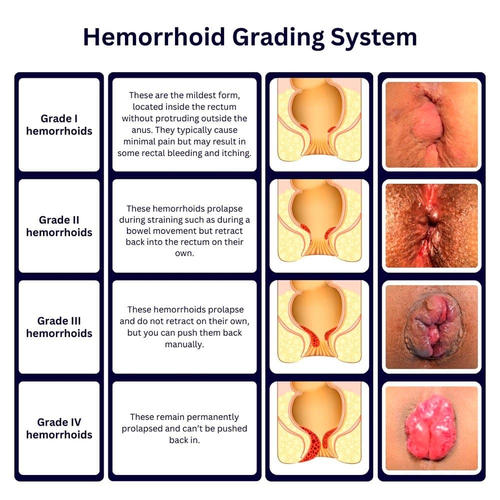 Chart of the four grades of haemorrhoids. Each row pairs a cross-section diagram with a clinical photograph: grade one sits inside the anal canal, grade two prolapses with straining and retracts, grade three needs to be pushed back, and grade four remains permanently prolapsed.