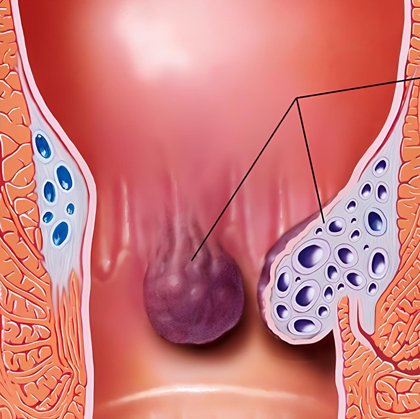 Anatomical cross-section of the anal canal. A swollen purple internal haemorrhoid hangs into the canal from the rectal lining, and a cutaway at the right shows the cluster of dilated veins inside the surrounding tissue that the swelling is made of.