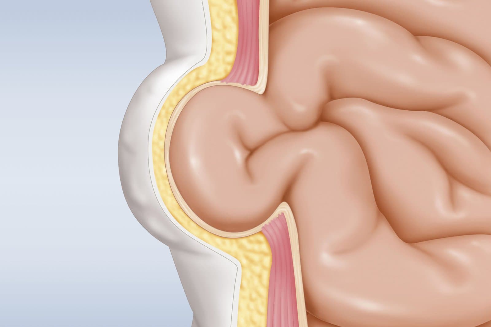 Cutaway illustration of the abdominal wall with a loop of intestine pushing through a gap in the muscle layer, forming a bulge under the skin.