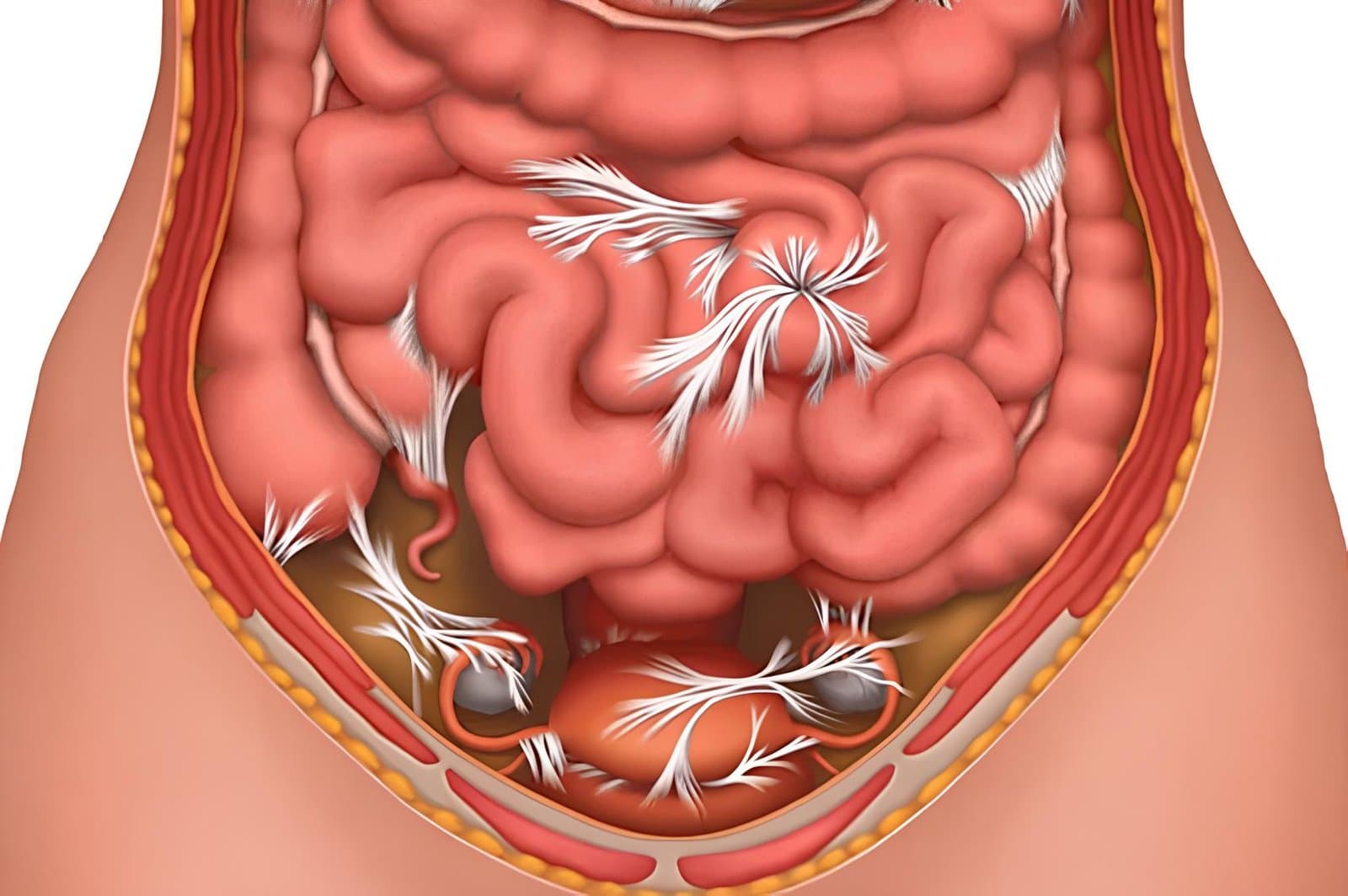 Illustration of the abdominal cavity with white bands of scar tissue stretching between loops of bowel, the pelvic organs and the abdominal wall.