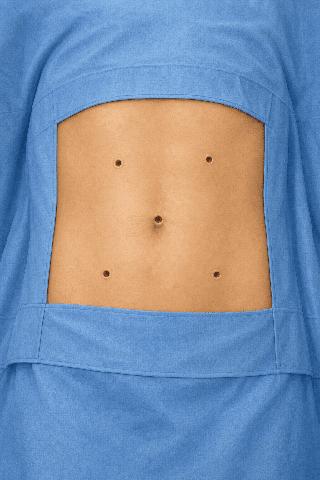 An abdomen showing through a rectangular window in blue surgical drapes. Five small round openings about a centimetre across are spaced across the skin, one of them at the navel.