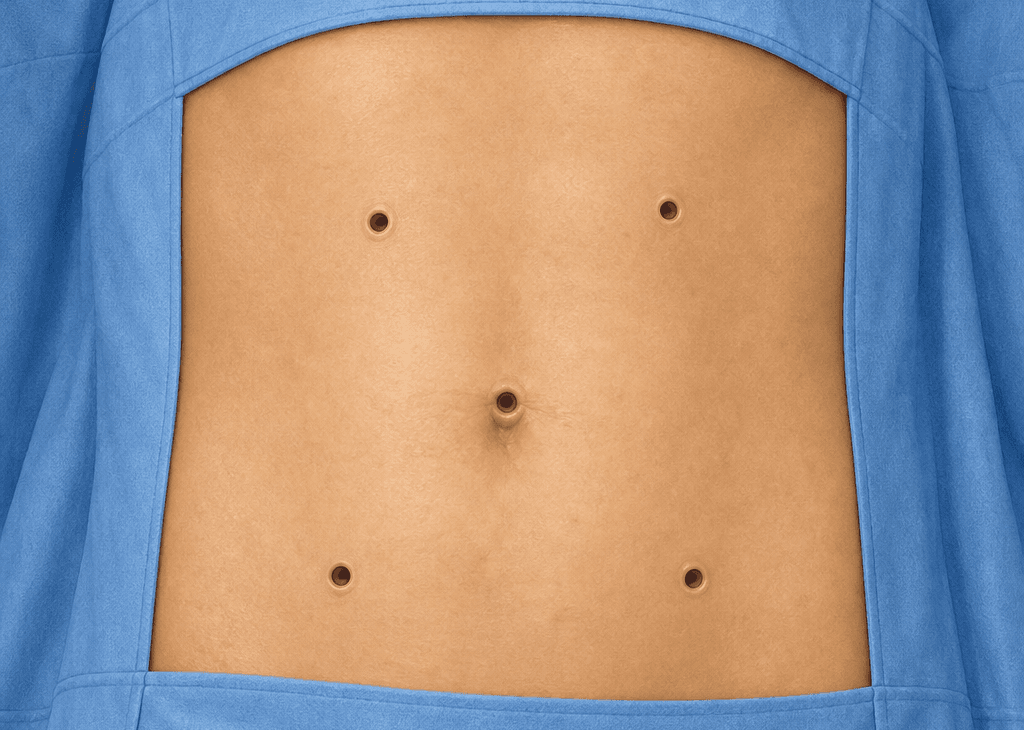 Illustration of a draped abdomen prepared for keyhole surgery, with five small port openings arranged around the navel.