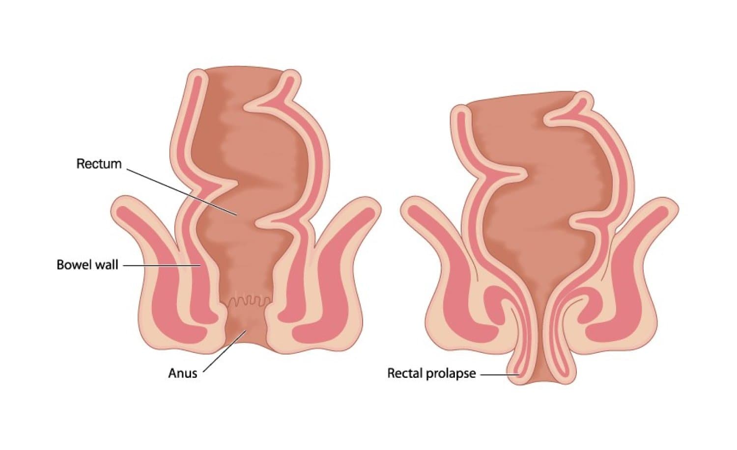 Two cross-section diagrams of the rectum side by side. The left is labelled Rectum, Bowel wall and Anus, and the bowel sits contained inside the body. The right is labelled Rectal prolapse, and the same bowel wall has turned outward and pushed down through the anus.