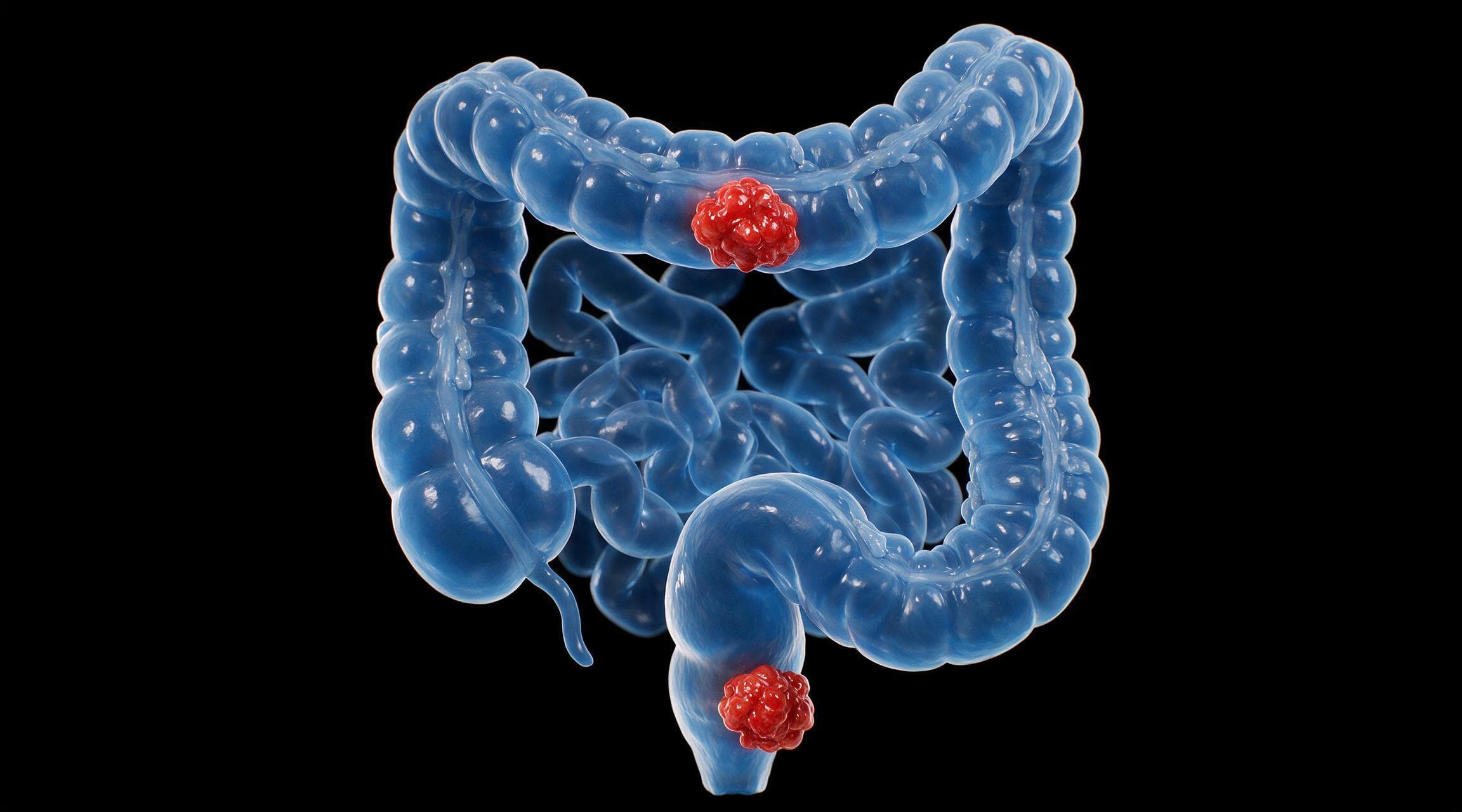 A render of the large bowel with the colon and the rectum shown in two distinct tones to separate them.
