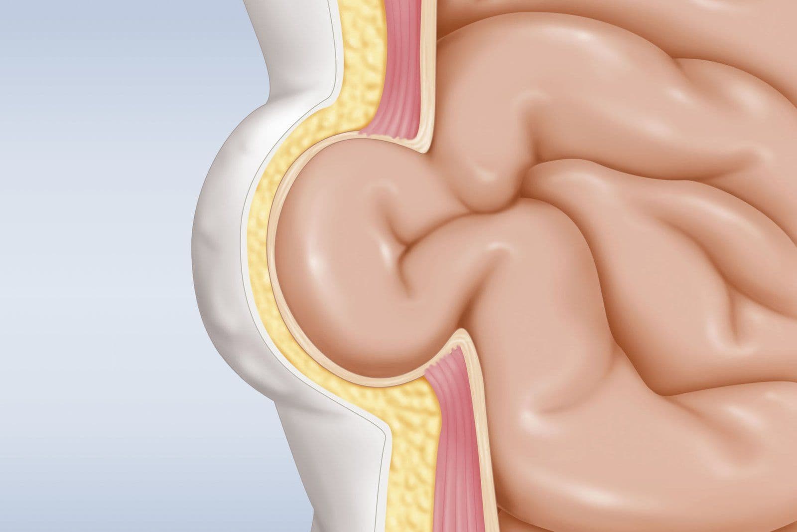 Anatomical cross-section of the abdominal wall. Skin and a yellow layer of fat sit over a band of muscle, and a loop of bowel pushes forward through a gap in that muscle to raise a smooth bulge under the skin.