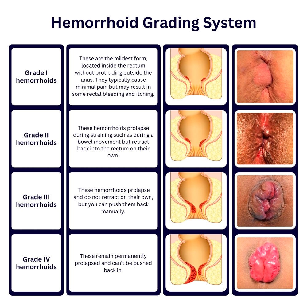 Haemorrhoid Grading System — Grade I through Grade IV with illustrations and descriptions